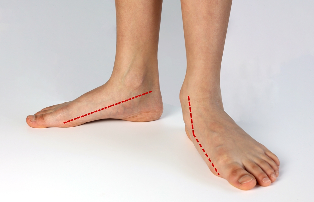 flat feet treatment