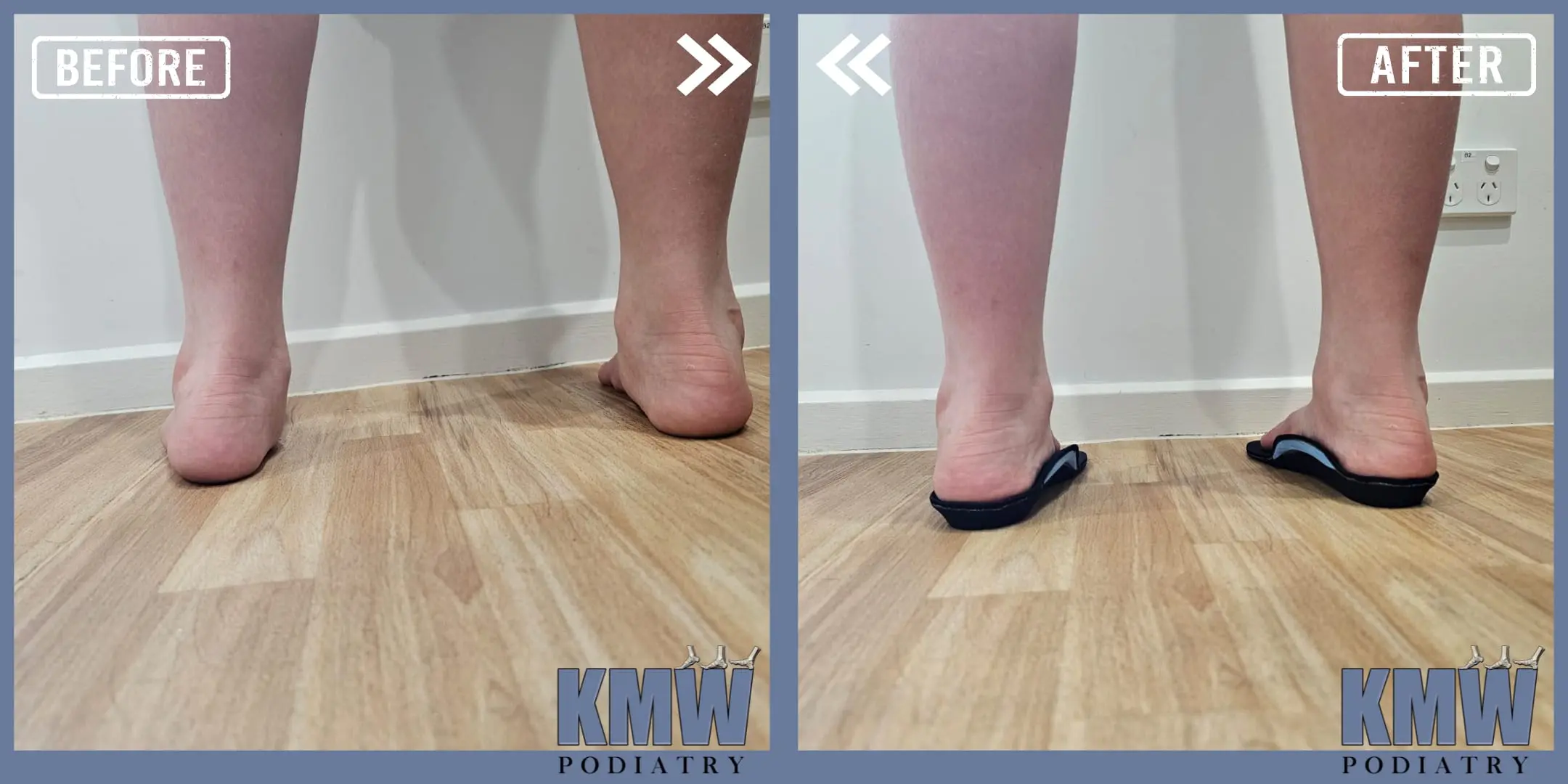 Before and After KMW Podiatry Treatments