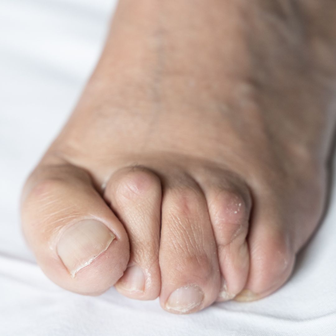 Toe Deformities Treatment Adelaide