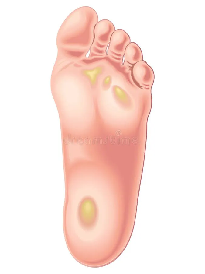 foot calluses medical illustration position feet 6