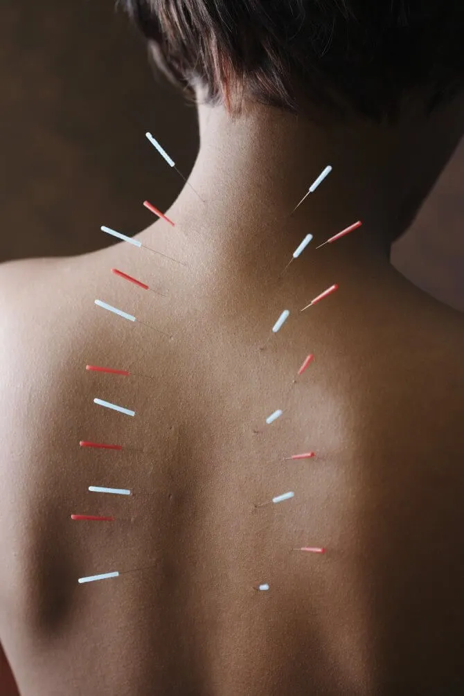 Dry Needling For Muscular Pain Adelaide