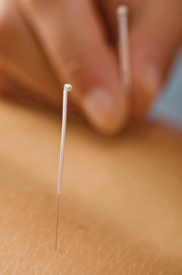 Dry Needling treatment in adelaide