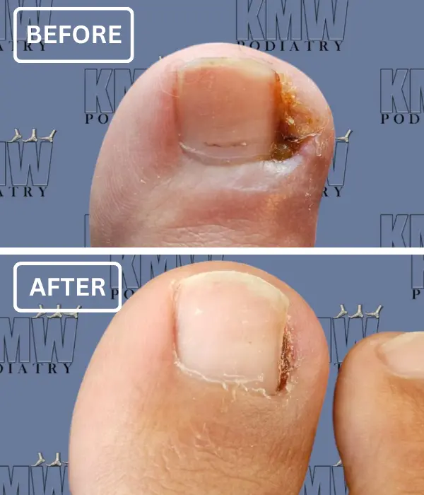 ingrown Toe Nail treatment by KMW podiatry