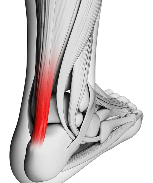 Achilles Tendon Injuries