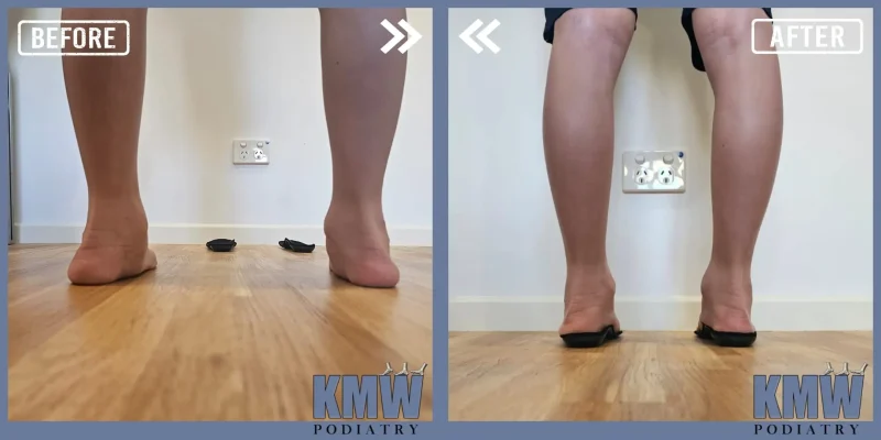 KMW Treatment Adelaide