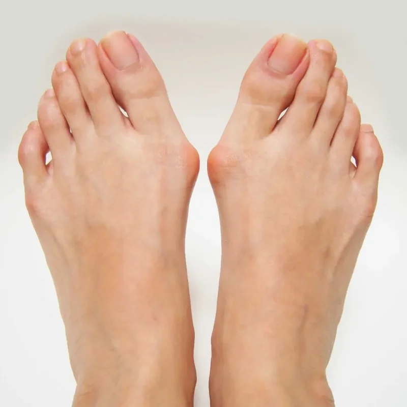 Bunions Treatment in Adeliade