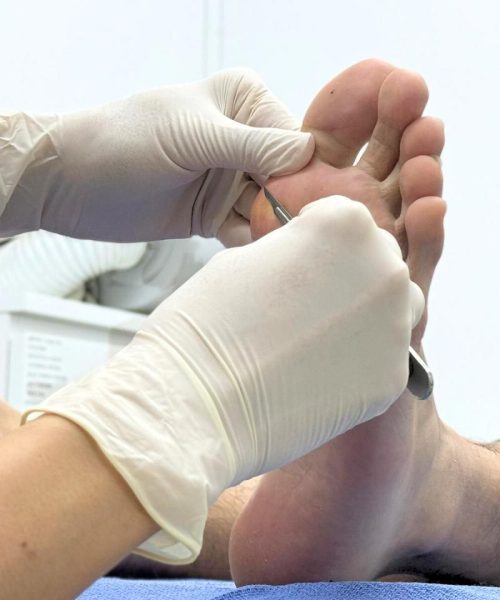 Corns and Callus Treatment