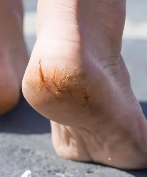 Cracked Heels Treatment Adelaide