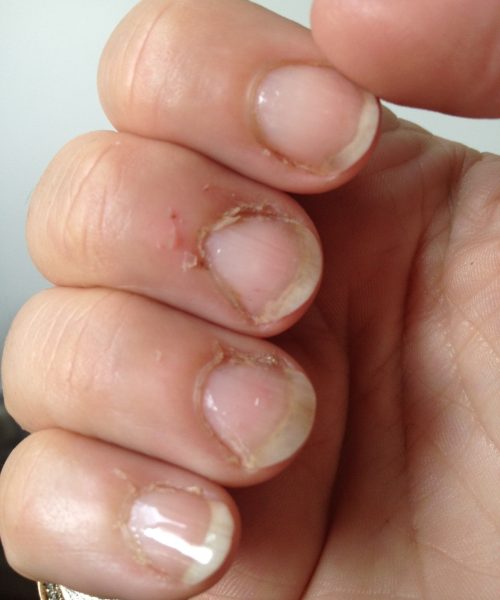 Damaged Nails Treatment In Adelaide