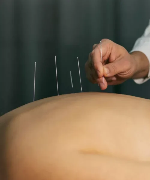 Dry Needling For Muscular Pain In Adelaide