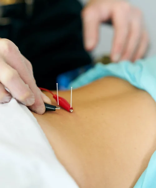 Dry needling Adelaide