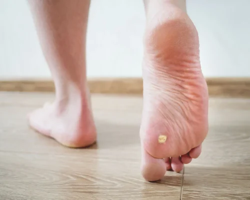 Foot Wart Treatment Adeliade