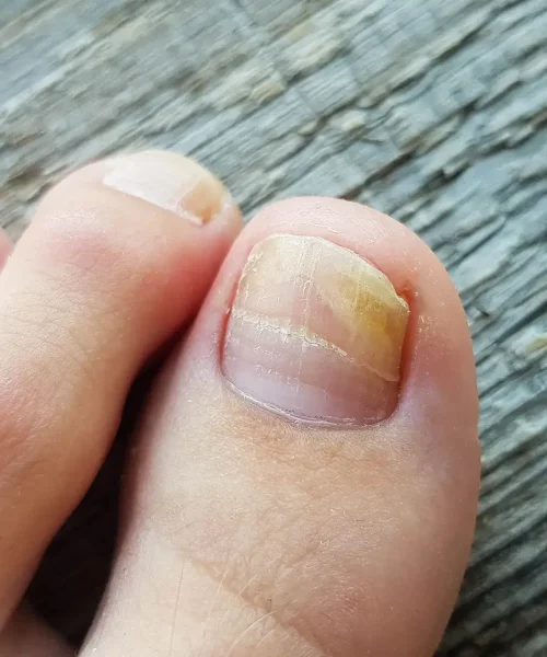 Fungal Nail Infection Treatment