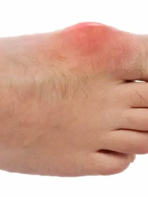 Gout Treatment In Adelaide