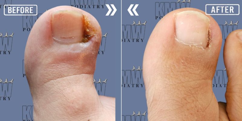ingrown toe nail treatment