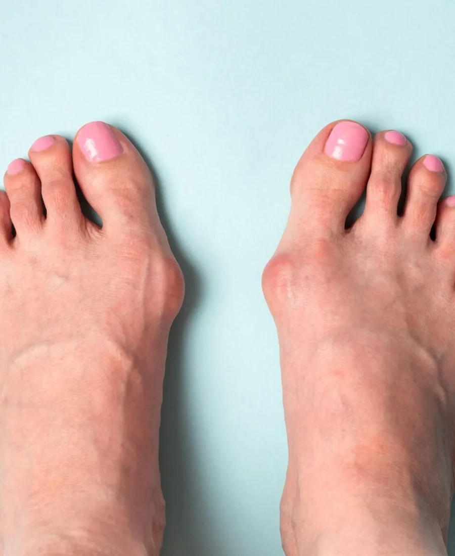 Juvenile Bunion Treatment In Adelaide