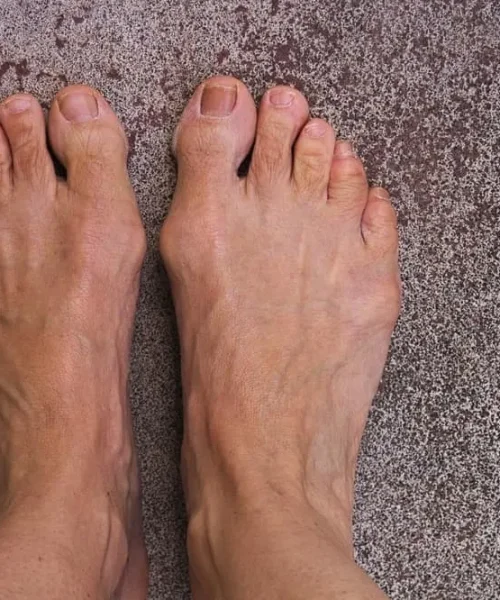 Juvenile Bunion Treatment In Adelaide