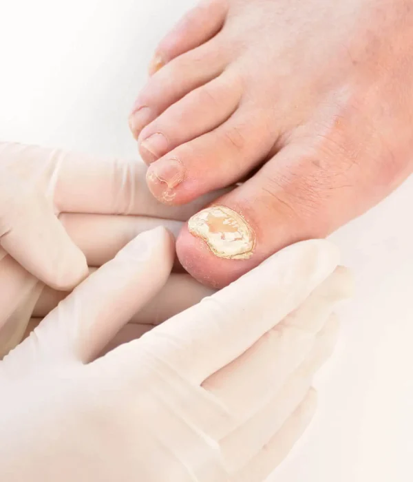 Nail Infection treatment in Adelaide