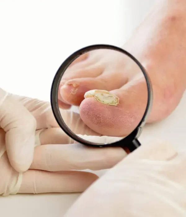 Nail infections treatment in Adelaide