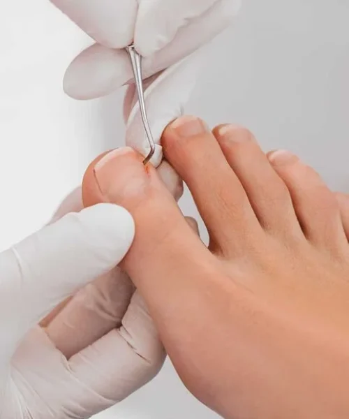 Nail trimming treatment in Adelaide