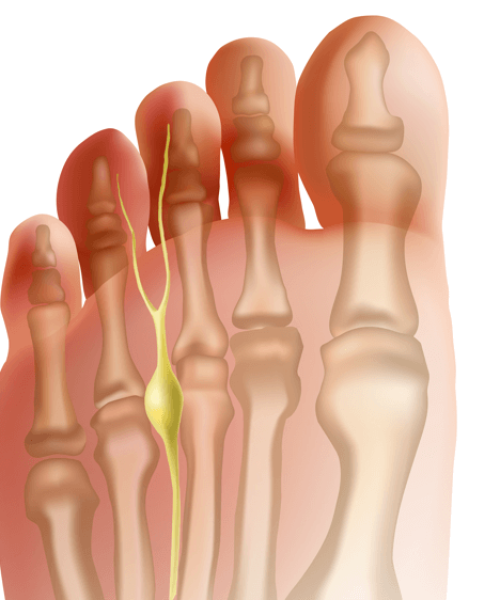 Neuroma Treatment Adelaide