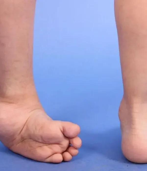 clubfoot treatment adelaide