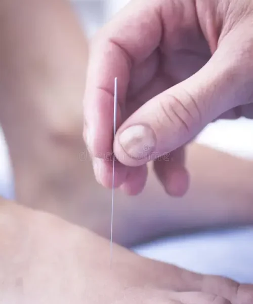 dry needling