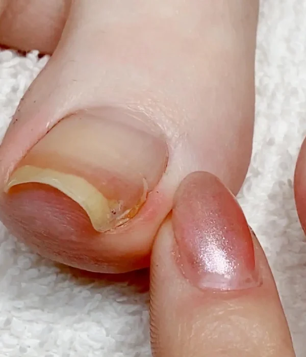 ingrown toenails Treatment Adelaide